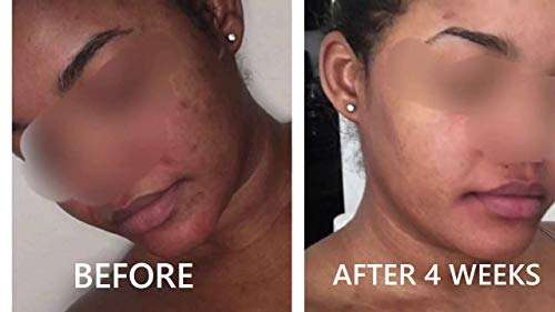 CHARCO - Skin To Internal Health® Kojic Acid Dipalmitate Powder, DIY Cream, Soap Etc Help for Skin Brightening, Smooth Face & Body, Dark Spot, Acne Scars, Uneven Skin Tone (25 Gm) 4