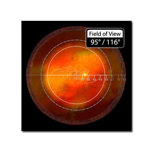 Volk SuperField-NC NON-Contact Slit Lamp Lens 3