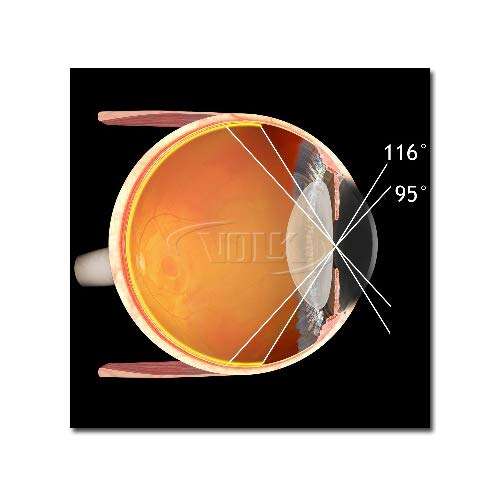 Volk SuperField-NC NON-Contact Slit Lamp Lens 4