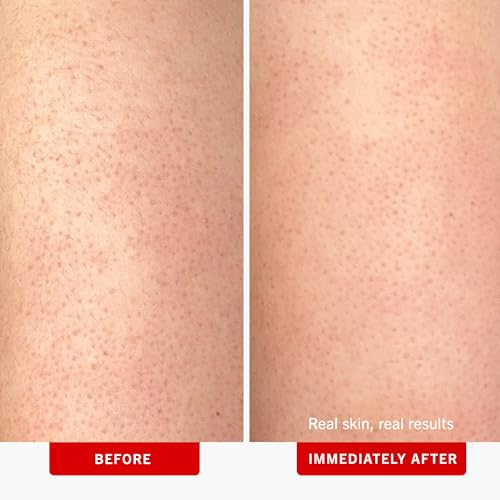 First Aid Beauty - KP Bump Eraser Body Scrub with 10% AHA, Keratosis Pilaris Skin Exfoliator with Glycolic and Lactic acids, Helps Reduce Chicken Bumps, Safe for Sensitive Skin, 2 oz 3