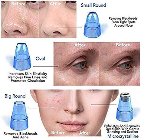 JAMDOFOX Derma Suction 4 in 1 Blackhead Extractor Remover Device Acne Pimple Pore Cleaner Vacuum Suction Tool for Men and Women 5