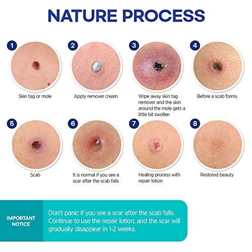 Skin Tag Removal Treatment-Skin Tag Remover-Made of Natural Plant Extracts-Simple and Easy to Apply Skin Tag Remover & Mole Corrector and Repair Lotion Set 6