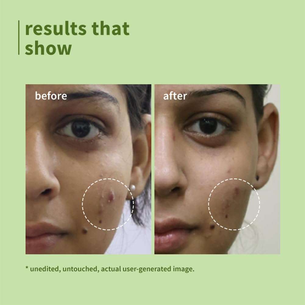 Plum Green Tea Pore Cleansing Face Wash for Oily, Acne Prone, Dry & Combination Skin | with Glycolic Acid | Fight Pimples & Control Excess Oil | Gentle Exfoliating & Non-Drying | Women & Men | 150ml 4