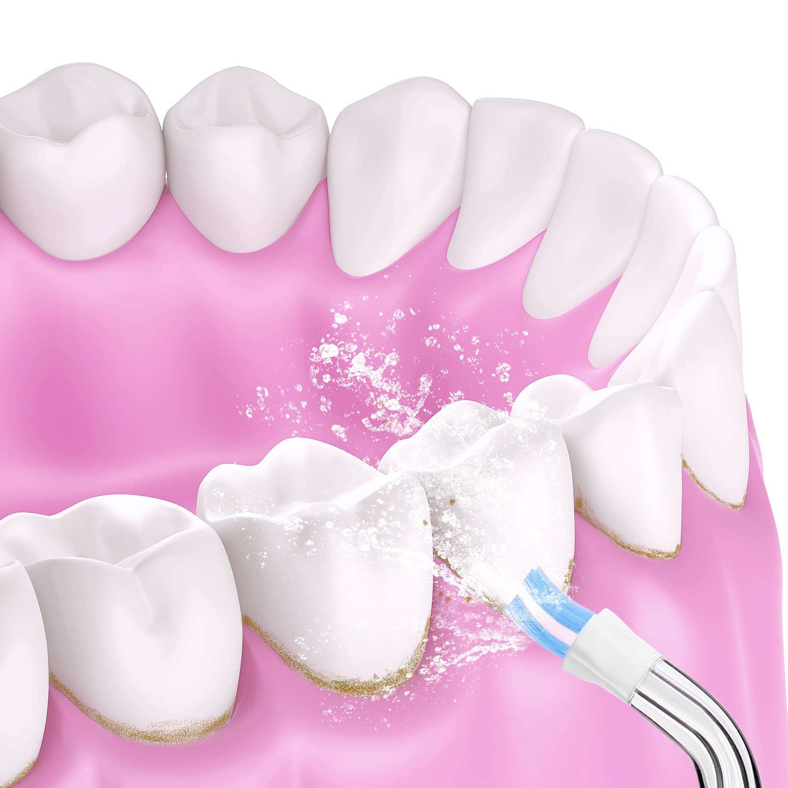 Plaque Seeker Replacement Tips,Dental Water Flosser Tips for Waterpik and Other Brand Oral Irrigators,2Pcs Flosser Refill Heads Replacement Heads(Plaque Seeker Tips) 3