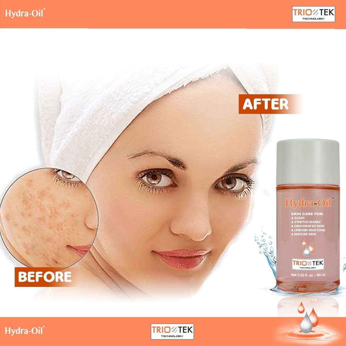 Hydra-Oil Scar Removal Serum - Scar Treatment for Face and Body - 50 ml Hydrating Oil for Acne Scar Remover, Stretch Mark Removal, and to Lighten Dark Spots - Vitamin E & A 2