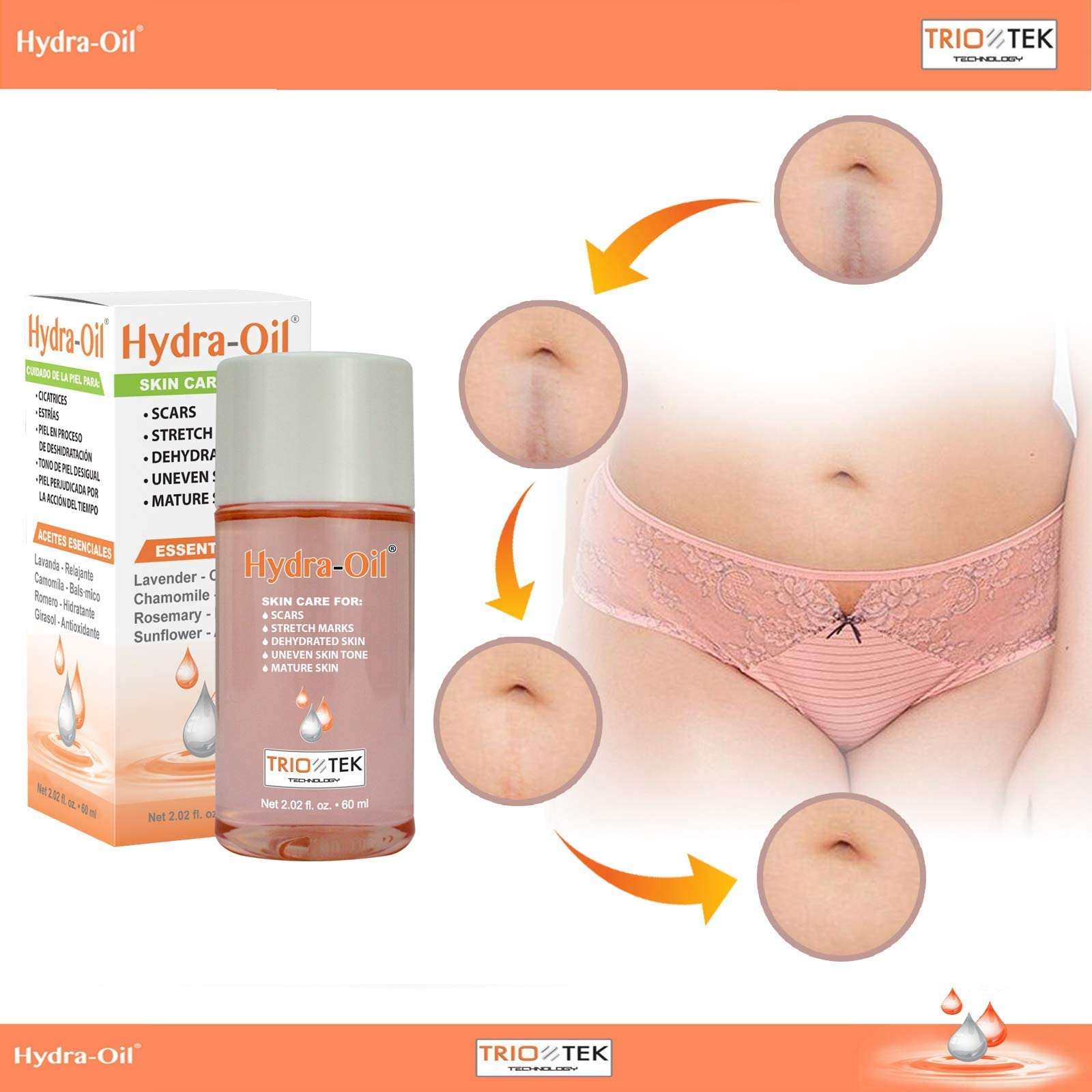 Hydra-Oil Scar Removal Serum - Scar Treatment for Face and Body - 50 ml Hydrating Oil for Acne Scar Remover, Stretch Mark Removal, and to Lighten Dark Spots - Vitamin E & A 4