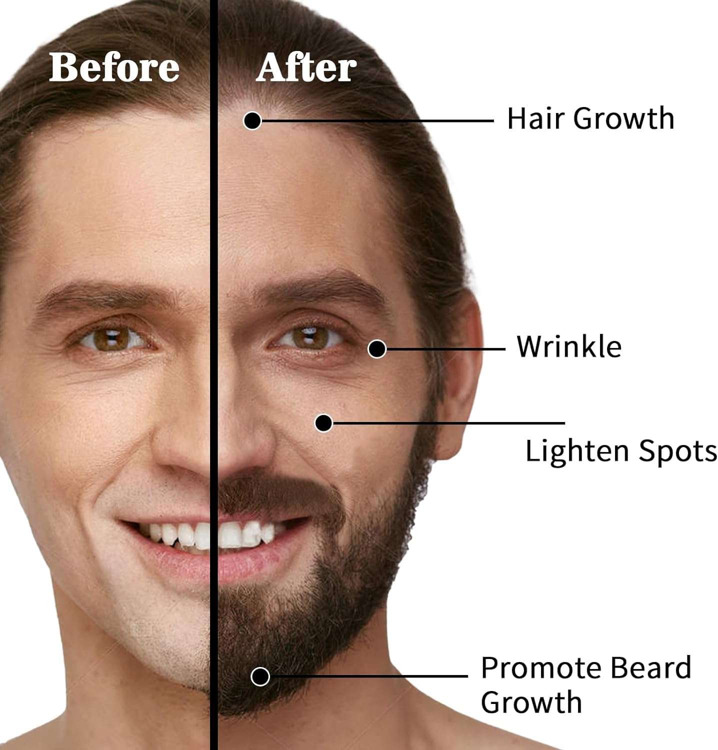 Kliffoo Derma Roller 1mm for Women And Men With Case For Face,Scalp Hair & Beard Regrowth,Treats Acne, Scar, Stretchmarks,Wrinkles -Safe & effective to use -Titanium Micro Needles Derma Roller 4