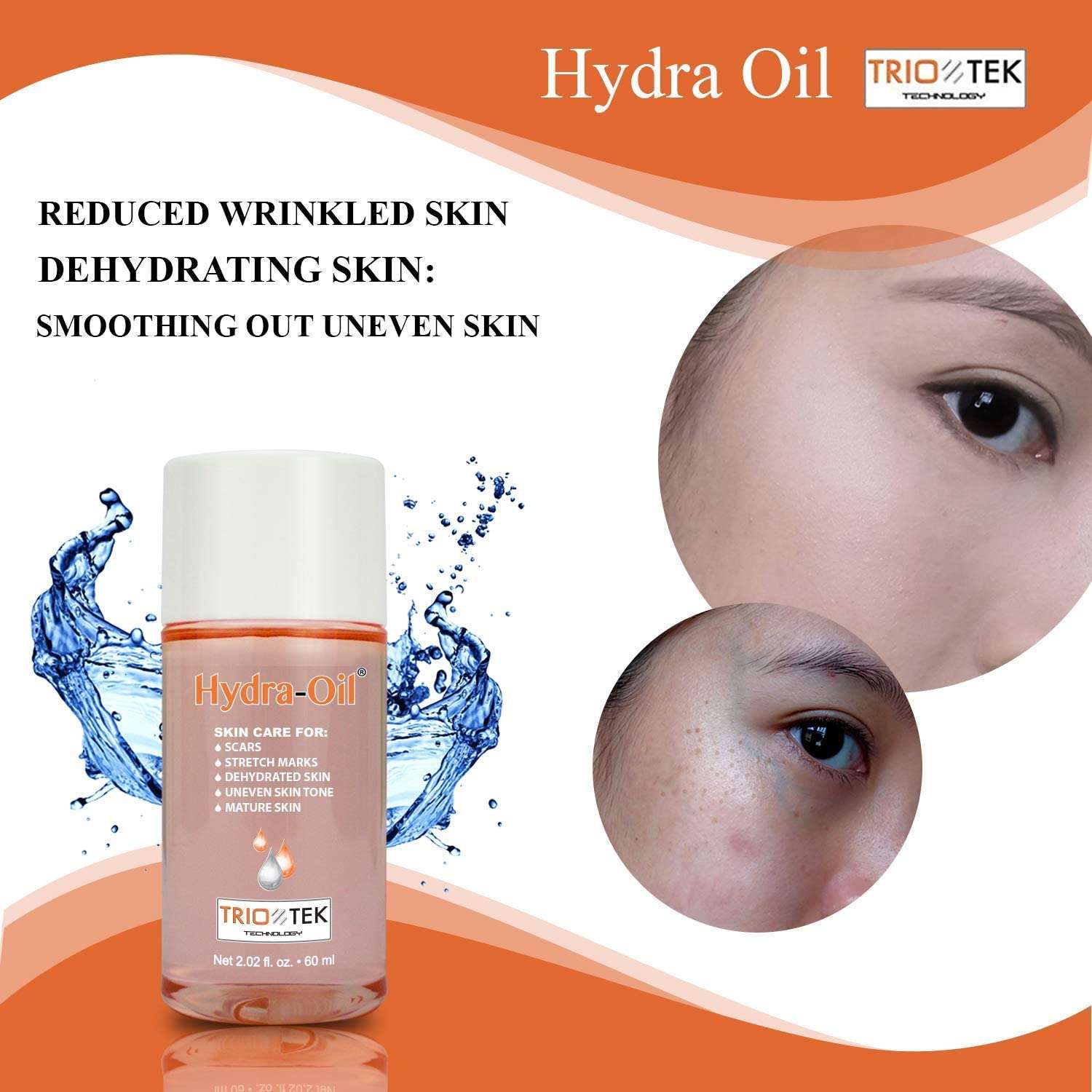 Hydra-Oil Scar Removal Serum - Scar Treatment for Face and Body - 50 ml Hydrating Oil for Acne Scar Remover, Stretch Mark Removal, and to Lighten Dark Spots - Vitamin E & A 6