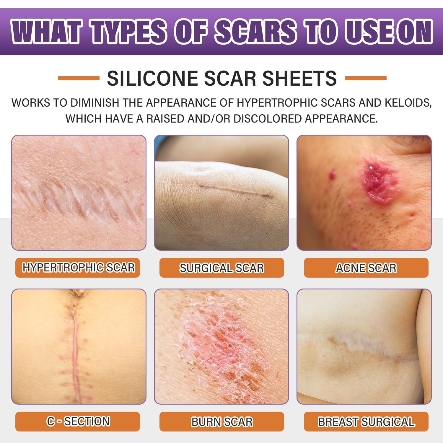 Silicone Scar Sheets,Silicone Scar Tape,Silicone Scar Removal Strips for Surgical,C-Section,Tummy Tuck,Keloid Scars (1.6"X 59" Roll-1.5M) Keloid Bump Removal 2