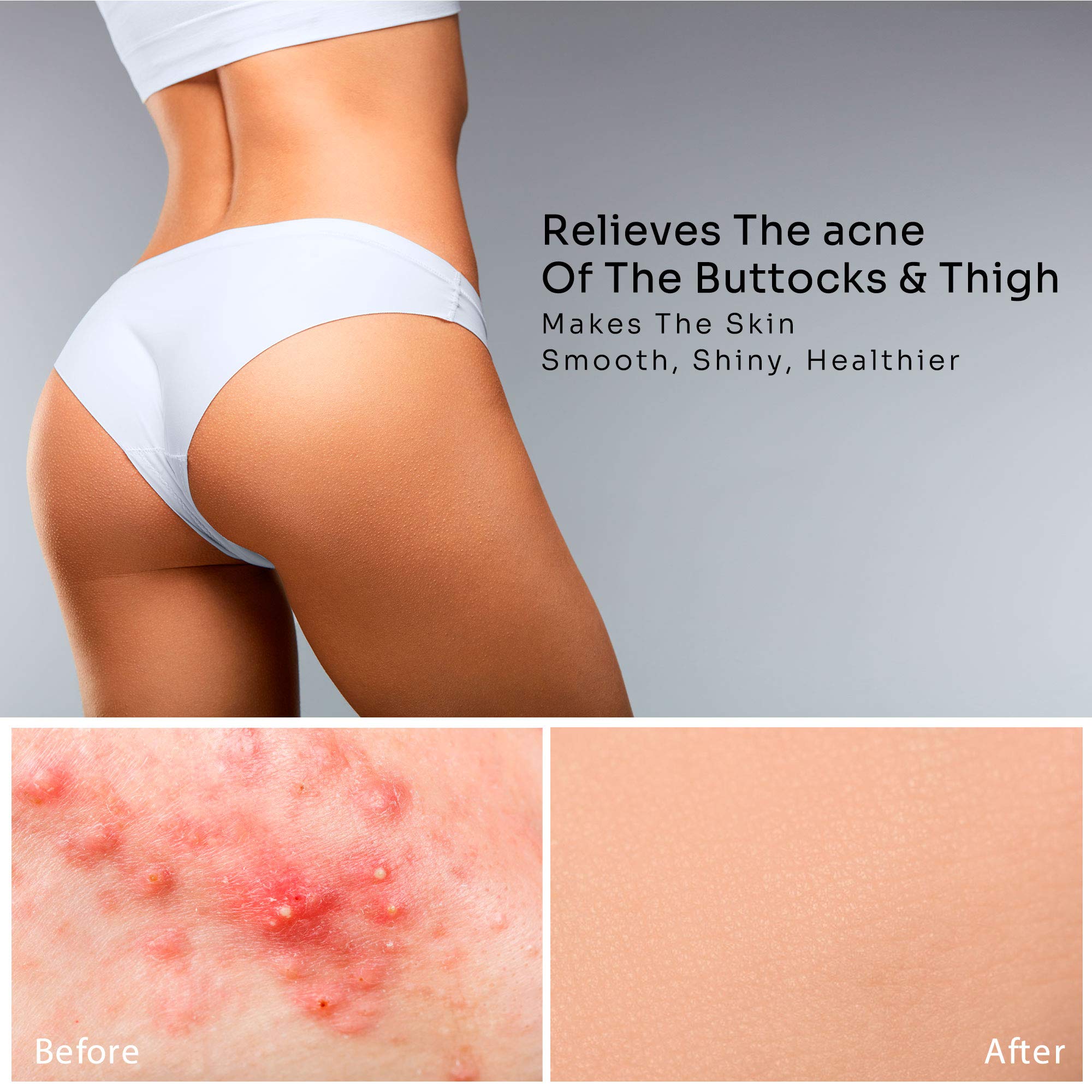 BellamiLuxx Butt Acne Clearing Treatment - 2 Pack, Effective Body Acne Treatment And Folliculitis Treatment, with 2% Salicylic Acid And Tea Tree Oil, Butt Acne Cream For Reduce Body Acne And Butt Acne. 3