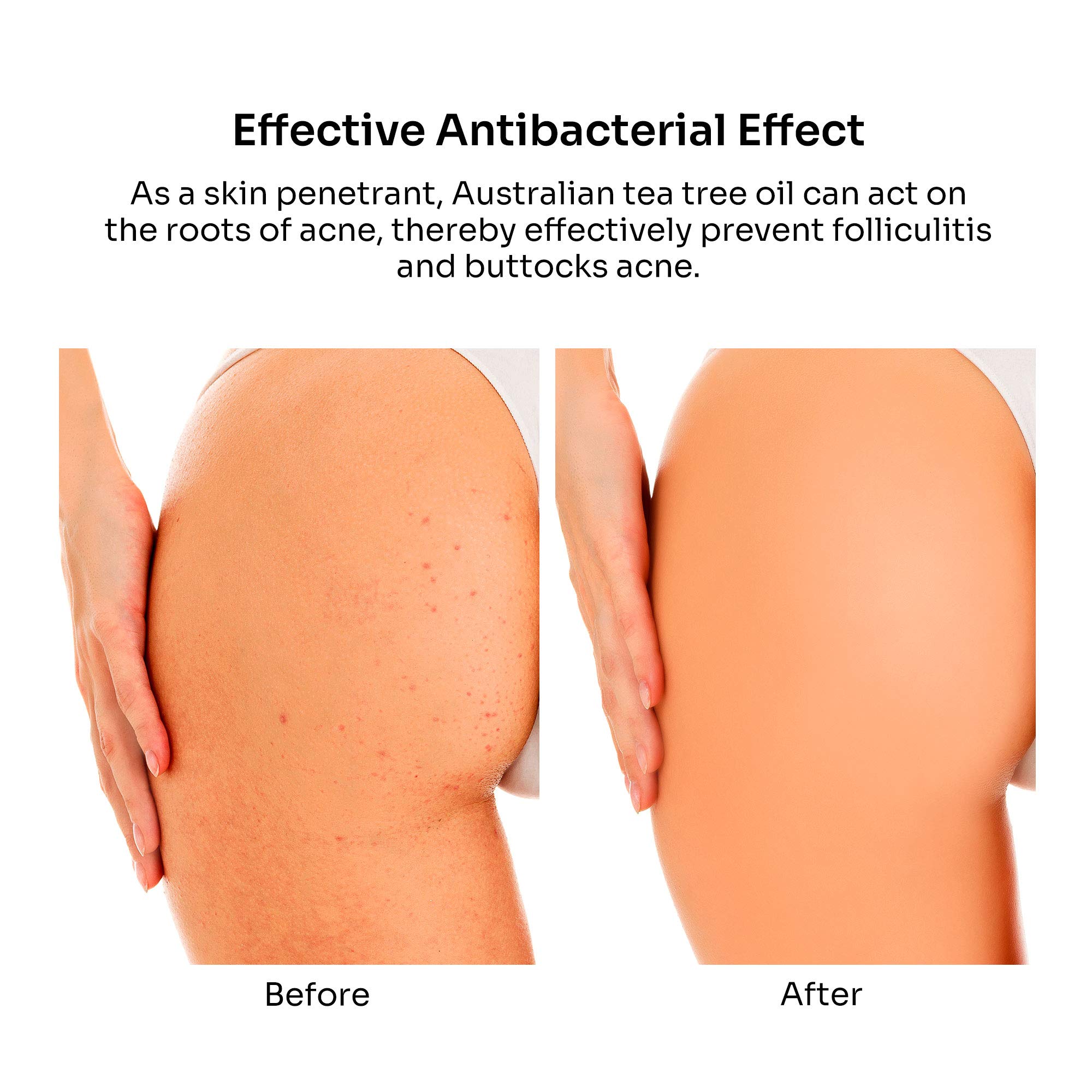 BellamiLuxx Butt Acne Clearing Treatment - 2 Pack, Effective Body Acne Treatment And Folliculitis Treatment, with 2% Salicylic Acid And Tea Tree Oil, Butt Acne Cream For Reduce Body Acne And Butt Acne. 5