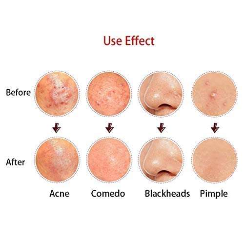 MAPPERZ Blackhead Acne Removal Needle Kit 4 Pcs Cleaning Tool Blemish Pimple Comedone for Women and Men Blackhead, Blemish, Whitehead Popping, Zit Removing for Risk Free Nose Face Skin with Case -PC1 4