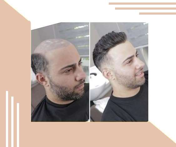 Kabello Hair Loss Solution Hair Patch/Wigs/Human Hair Toupee Mono Base 6 inch Hair (10x7, Light Brown) 6