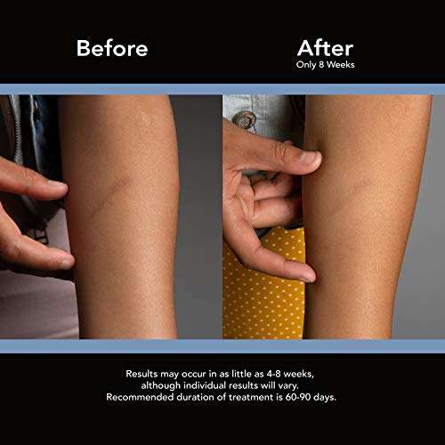 ScarAway Advanced Skincare Silicone Scar Sheets, Silicone Scar Sheets for Body Scar, Surgical Scar, Burn Scar, Acne Scar and Keloid Scar Treatment, 12 Reusable Sheets 3