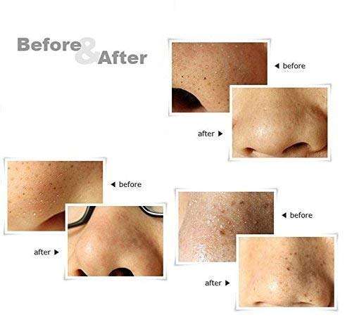 LA VENUST Stainless Steel Blackhead Whitehead Pimple Remover Acne Needles Set of 4 5