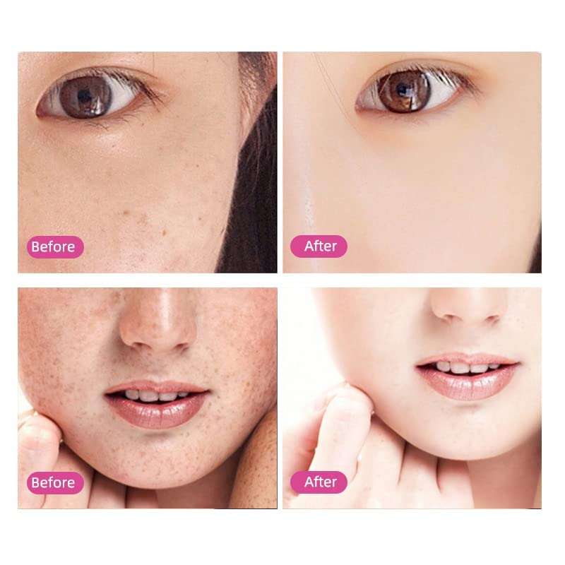 WynxCare Mole & Wart Remover | Painless Spot Pimple Freckle Skin Tag Remover Kit | Portable Plasma Laser Machine | Beauty Enhancer for Skin Care 2