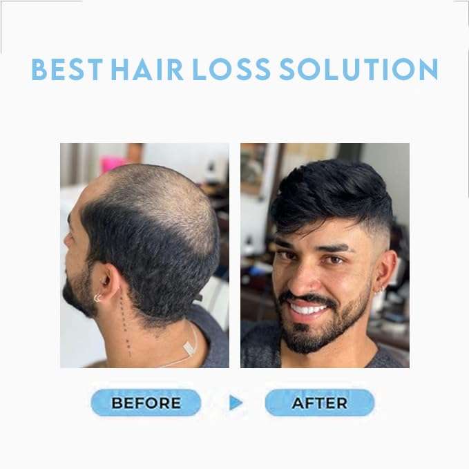 Majik Monofilament Human Hair Patches Hair Wig Hair Toupee with PU Poly Skin Coating around Cap for Men 10x8 Inch Medium Brown with Brush Tape Clips 6