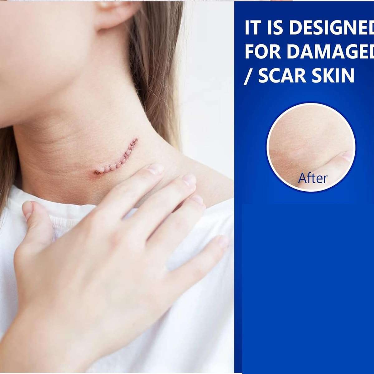 Advanced Scar Gel for Surgical Scars, Face, Body, Legs, Burns, Acne, C-Section, Stretch Marks, Keloids - Effective Scar Removal for Men and Women, Suitable for Old & New Scars (100% New -1 Bottle) 4