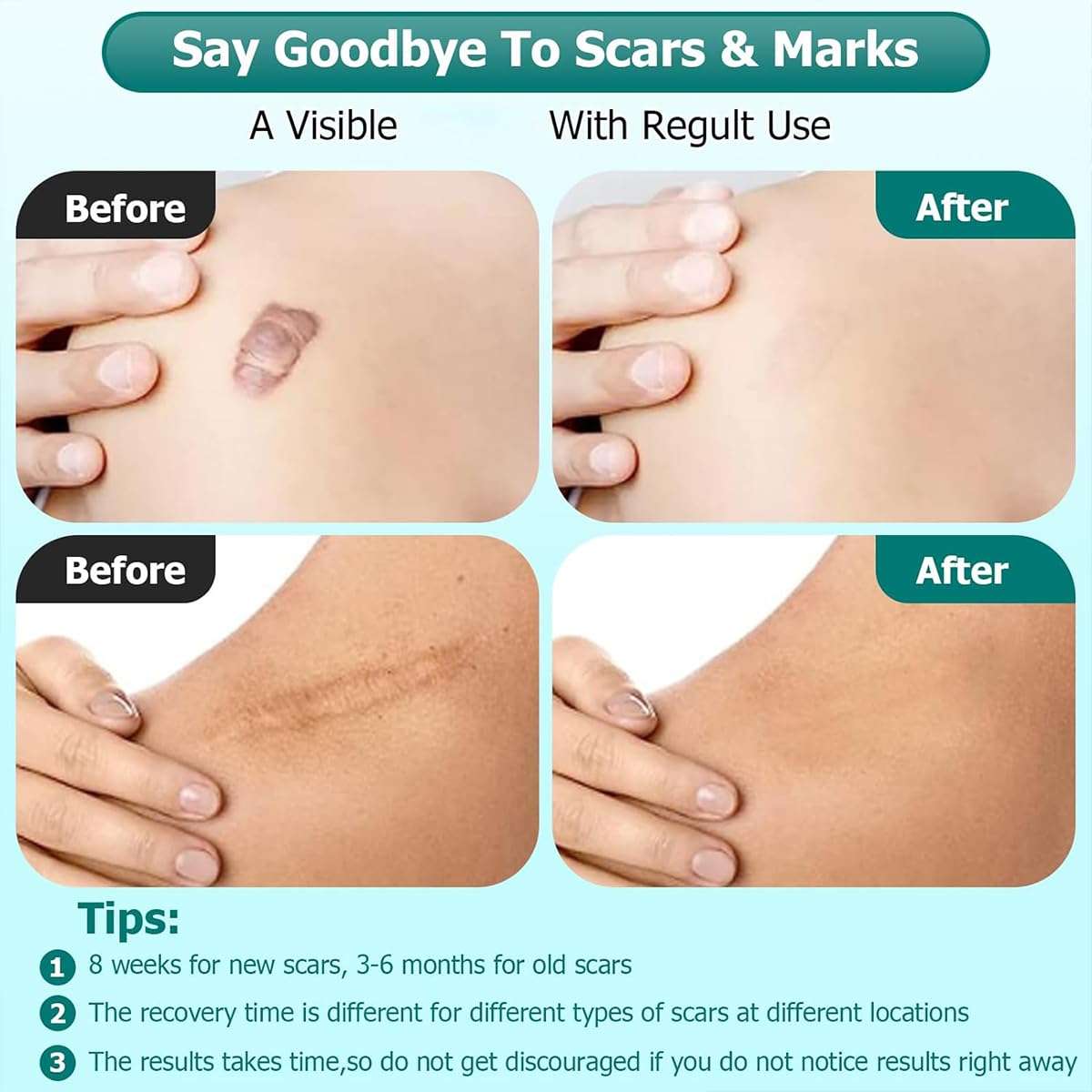Advanced Scar Gel for Surgical Scars, Face, Body, Legs, Burns, Acne, C-Section, Stretch Marks, Keloids - Effective Scar Removal for Men and Women, Suitable for Old & New Scars (100% New -1 Bottle) 3