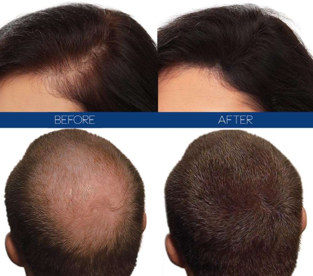 Hair4Real Hair Building Hair Fiber Refill Pack - 50 Gms (25g Black & 25g Dark Brown) 3