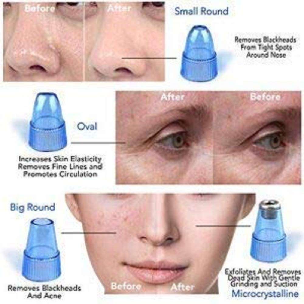 SARJUDAS ENTERPRISE Electric Microdermabrasion Derma Suction Blackhead Cleaning Remover Vacuum Tool Machine for Pimple Sucker and Facial Cleanser Device for Pores Acne Nose Skin (White) 6