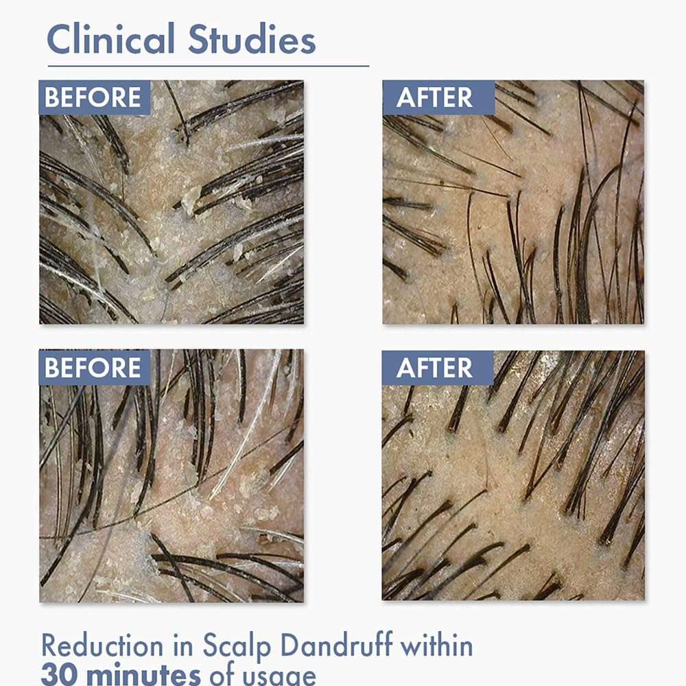 ThriveCo Anti-Dandruff Pre-Shampoo Serum for Itchy, Dry & Flaky Scalp | With Octopirox, Pentavitin & Arginine | Reduces Hair Breakage & Strengthens Hair for Men & Women | 10ml 6