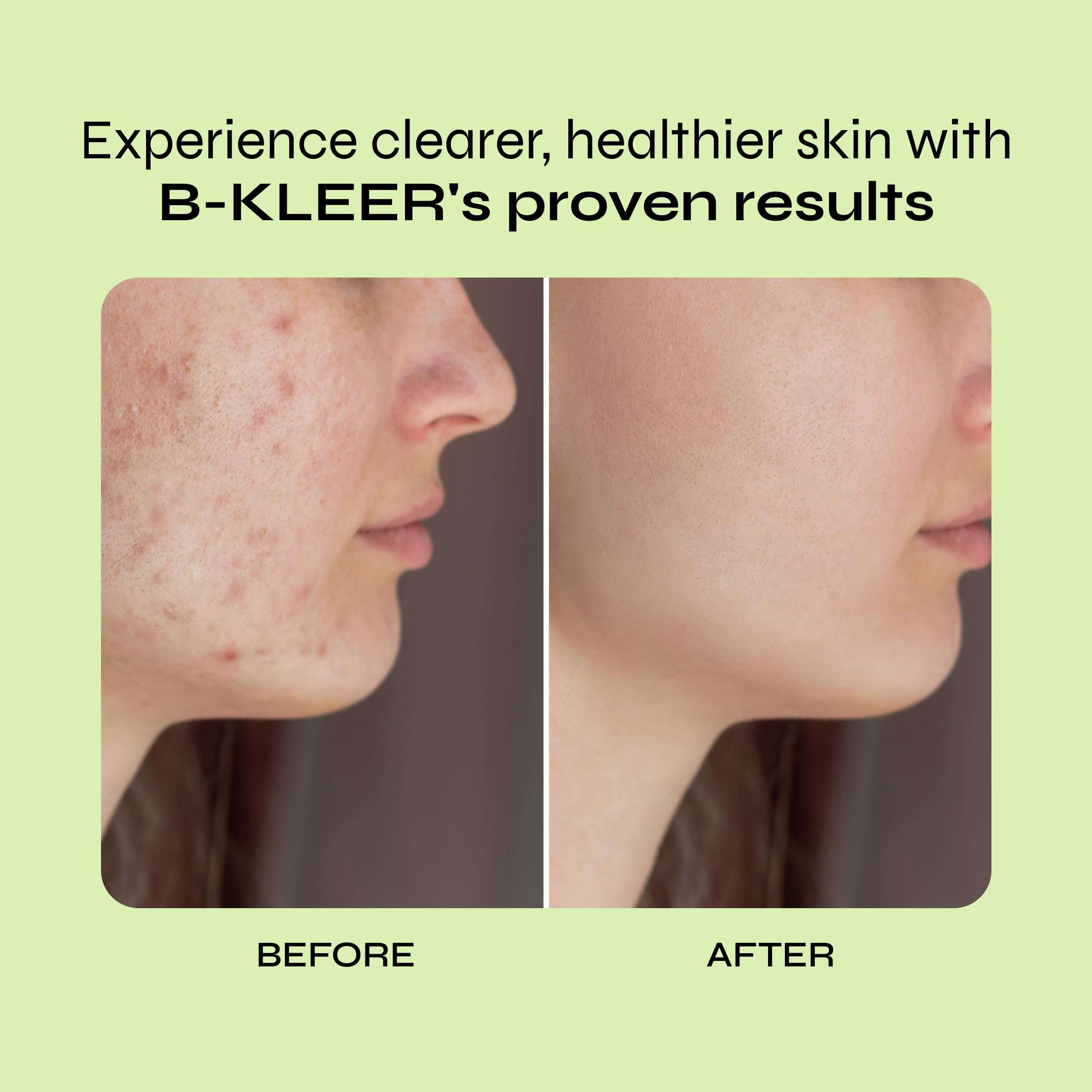 A-Cute Derm B-Kleer Cleansing Gel Acne Cleanser that Purify and Protect Your Skin from Clogged Pores for All Skin Types (8oz) 5