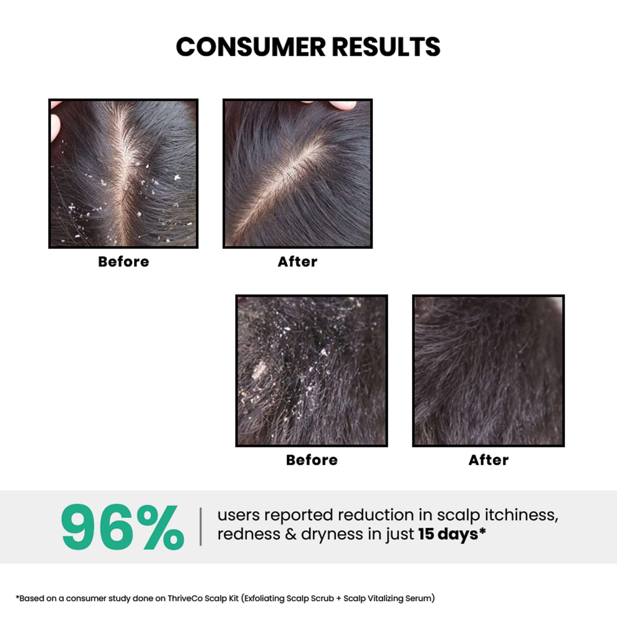 ThriveCo AHA BHA PHA Exfoliating Scalp Scrub | Promotes Hair Growth, Clears Dandruff, Dead Skin, Oil & Product Buildup | Works on Dry, Flaky & Itchy Scalp | For Men & Women | Travel-Friendly | 25ml 6