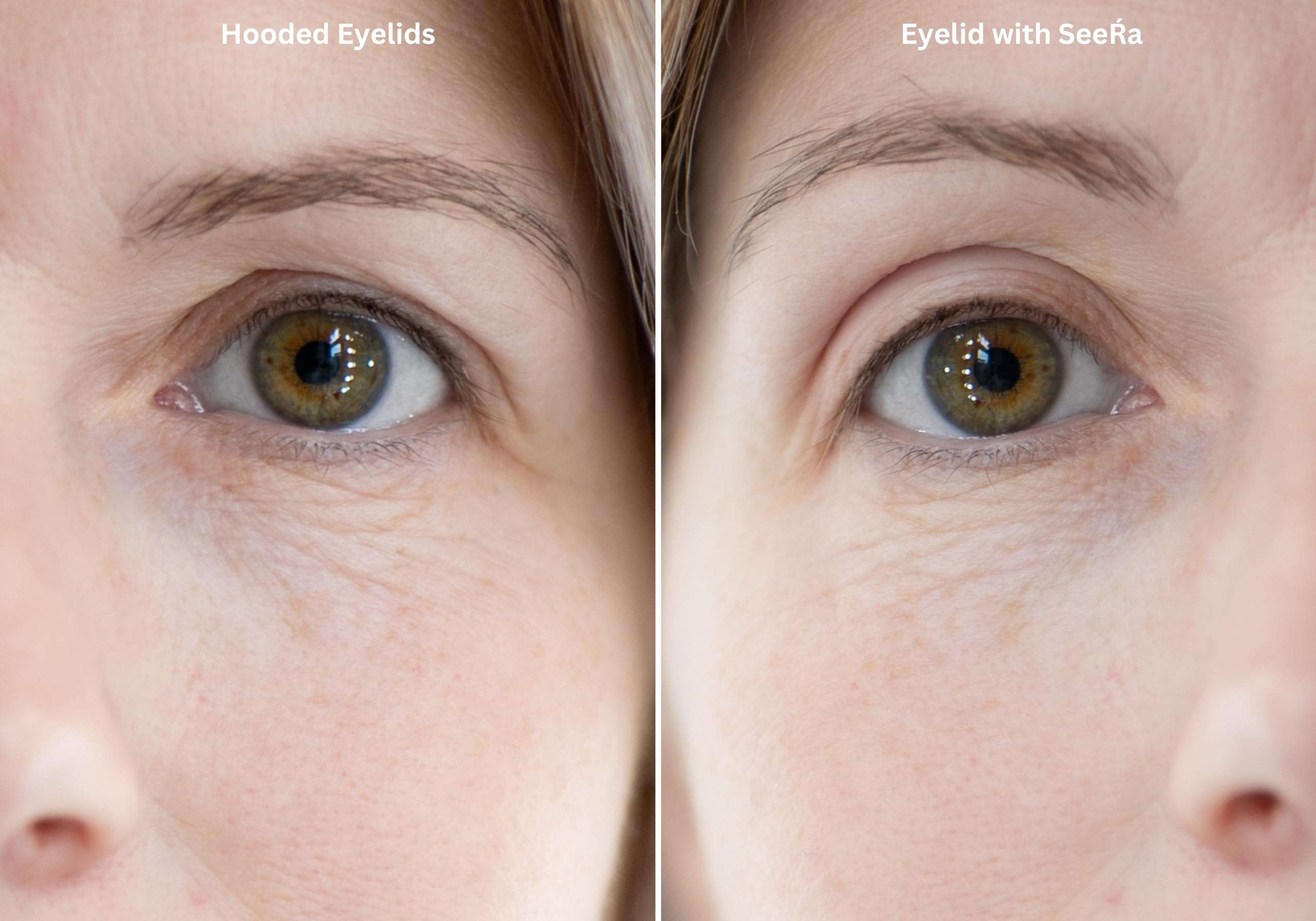 SeeRa: Instant Lifting Eyelid Tape for Hooded & Droopy Eyes - Hypoallergenic, Waterproof, Invisible Eye Lift Strips, Non-Surgical, Eyelid Lifters & Stickers-90pcs (4mm-7mm) (4mm-Petite) 3