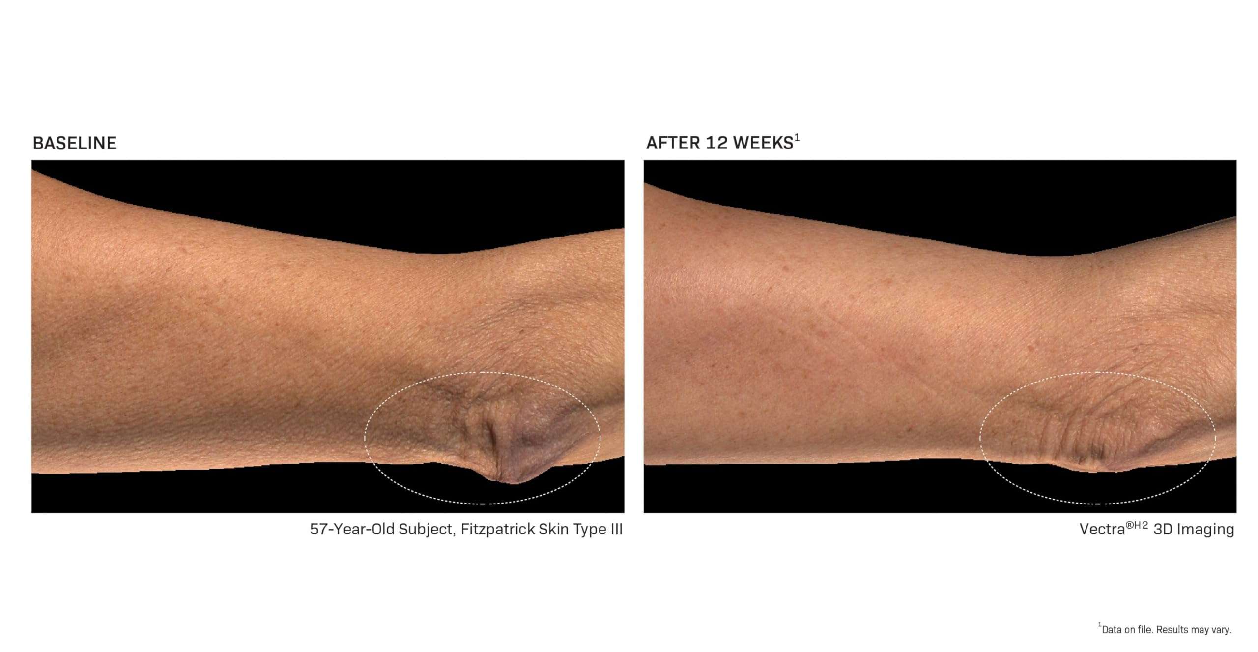 Revision Skincare BodiContour™, Contouring Body Lotion with iFirm® Technology, Firms, Tightens & Lifts Sagging, Crepey Skin, Enhances Results with Body Contouring & Weight Loss Medications, 8 oz 6