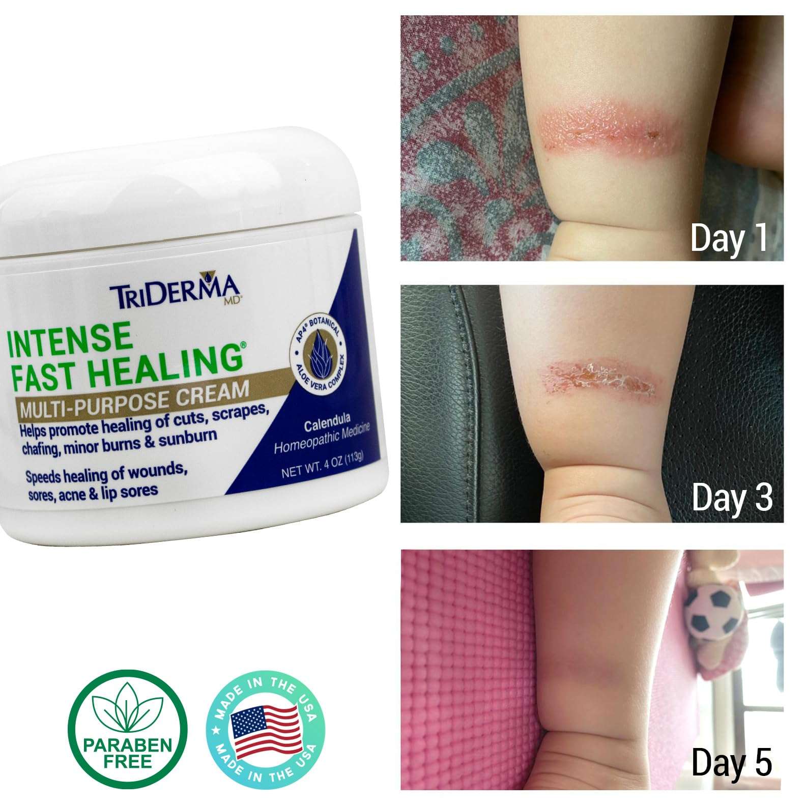 TriDerma Intense Fast Healing Cream, Decreases Healing Time for Minor Irritations, Rashes, Scrapes, Cuts 4 Ounces 4