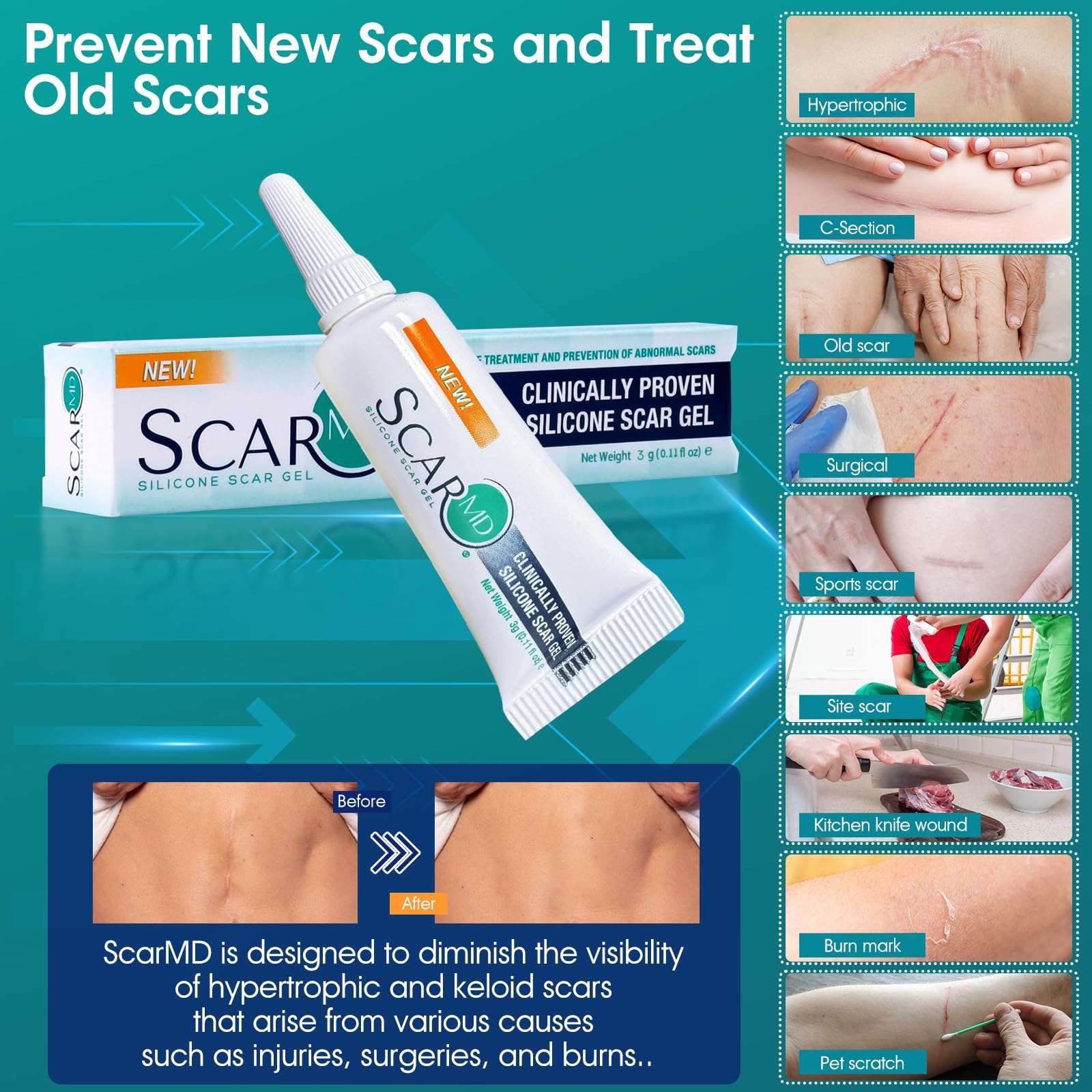 Scar Gel Scar Cream, Keloid Bump Removal, Advance Scar Gel for Surgical Scars,Body,Leg, Burns,C-Section, Stretch Marks, Reduces Discomfort, 0.1oz 3